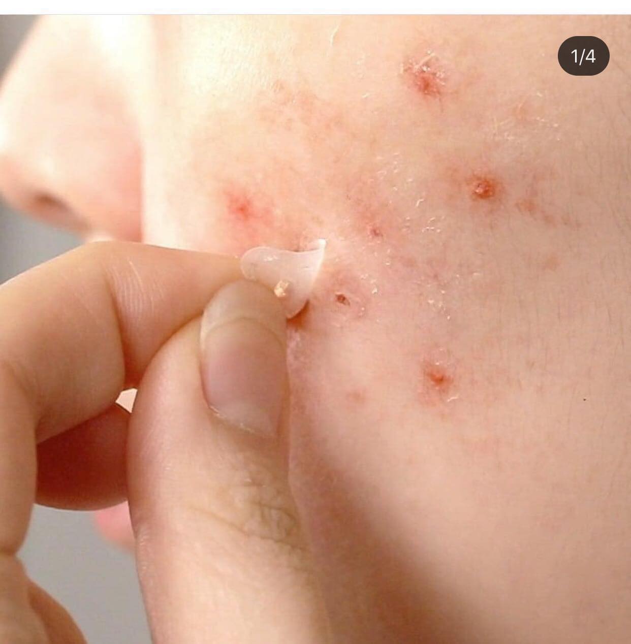 Miếng dán mụn Cosrx Acne Pimple Master Patch (Đỏ) / Cosrx Clear Fit Master Patch (Đen) / Cosrx AC Collection Acne