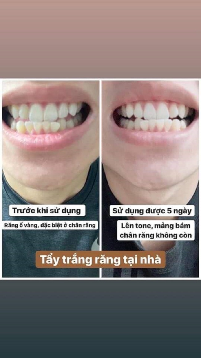 Máy làm trắng răng Nhập Khẩu USA
