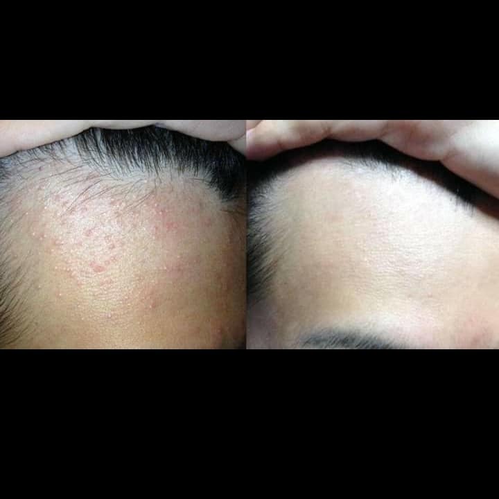 GEL TRỊ MỤN NHẬT BẢN 𝐒𝐀𝐓𝐎 𝐃𝐀𝐋𝐀𝐂𝐈𝐍 𝐓 𝐆𝐄𝐋 1%