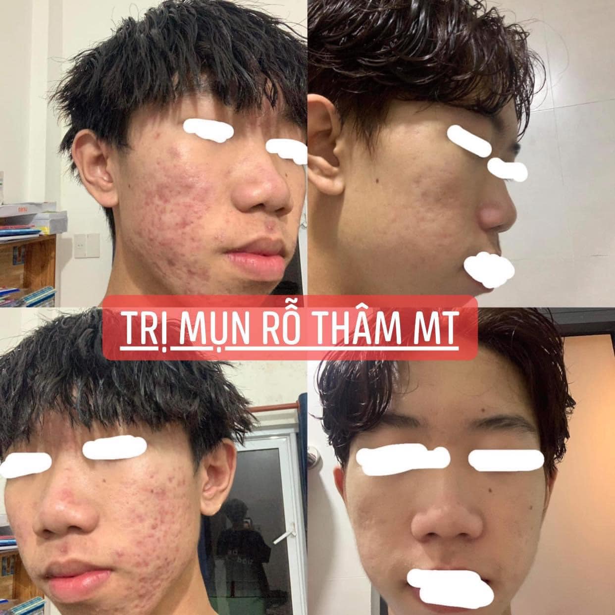 Compo 2 lọ Thảo Dược Sạch Mụn MT (100ml)