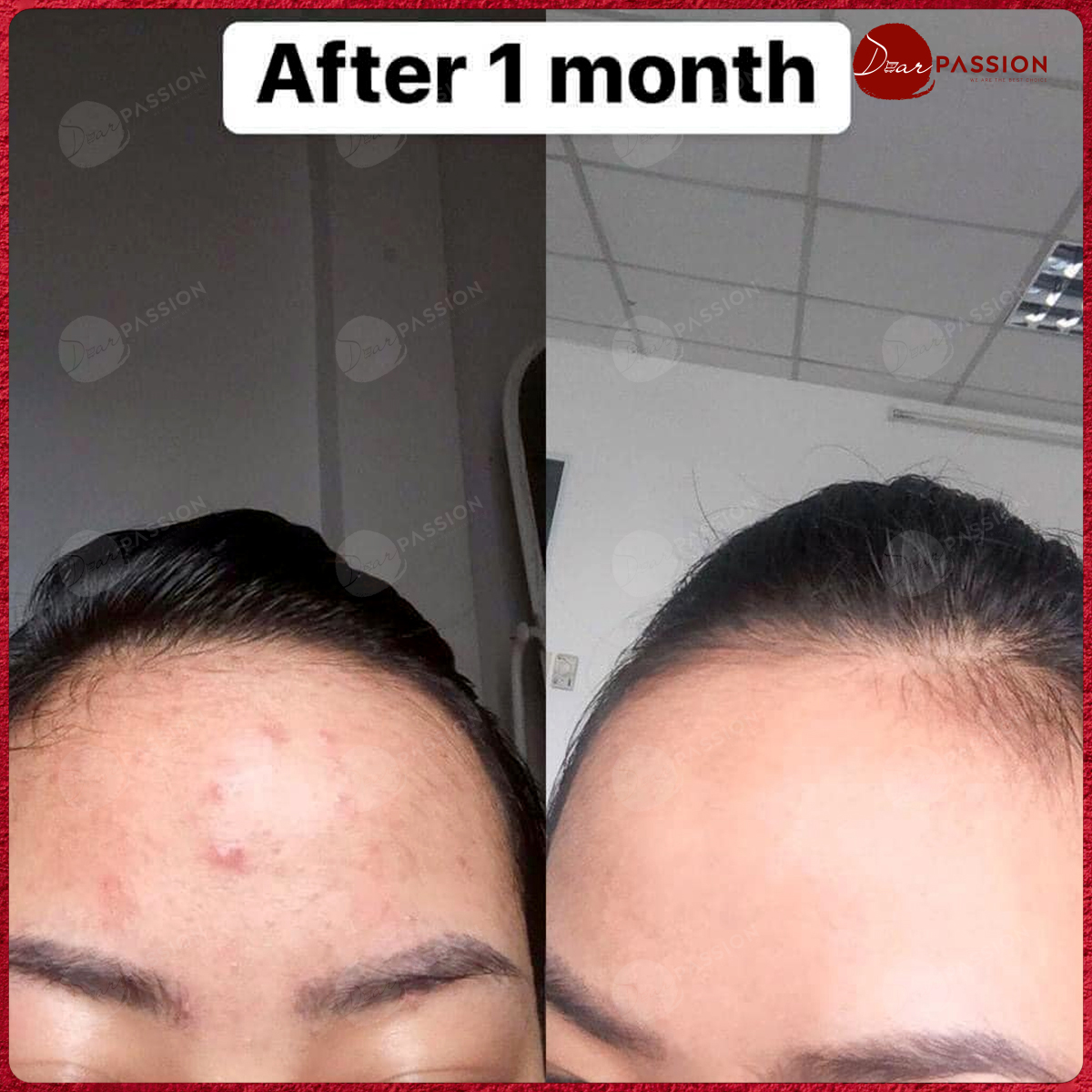 Gel Chấm Mụn Cấp Tốc T-Zone 8ml Skincare Spot Zapping Gel