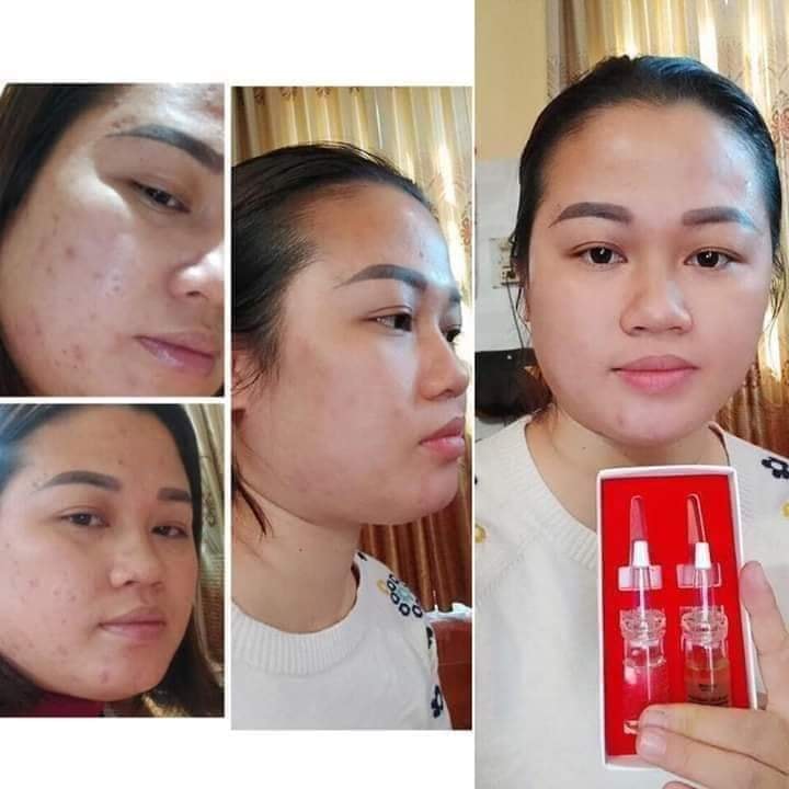 VUA TRỊ MỤN LINH HƯƠNG
