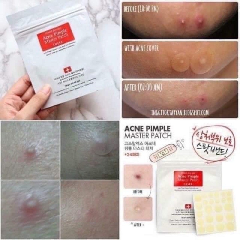 Miếng Dán Mụn Cosrx Acne Pimple Master Patch