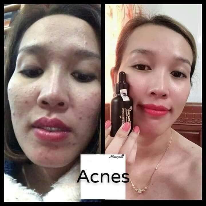 Serum Trị Mụn Hanayuki - Hana Acnes