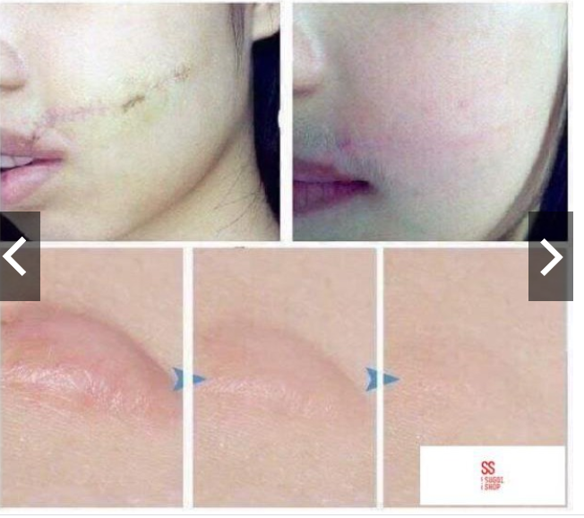 Kem sẹo Gentacin Nhật Bản 10gr