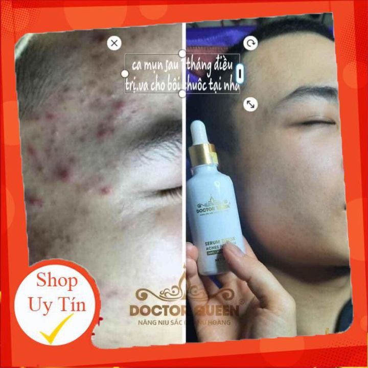 Serum Detox Mụn Doctor Queen 🔥𝐍𝐄𝐖🔥 (Ngừa Tất Cả Các Loại Mụn,Thâm,Đào Thải Phục Hồi Tái Tạo Da,Da Yếu, Giãn Mao Mạch)