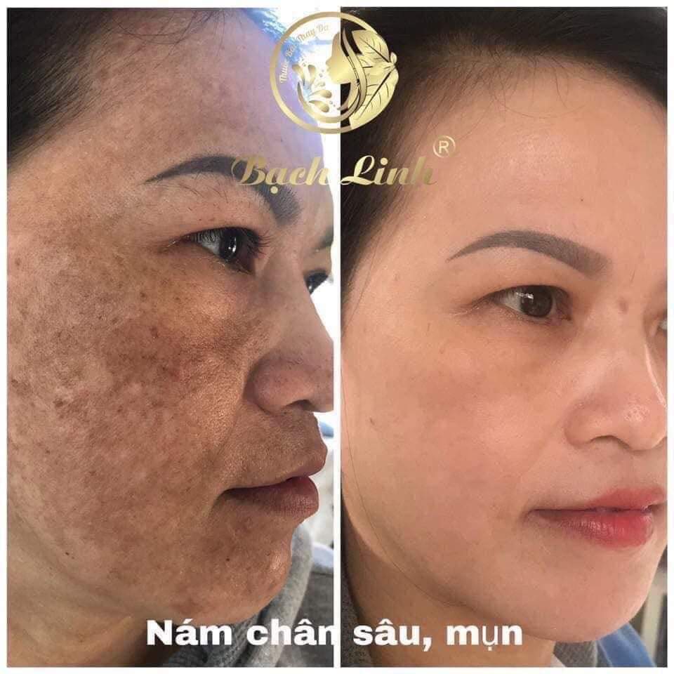 03 plus Bách y Sâm bay mụn, nám