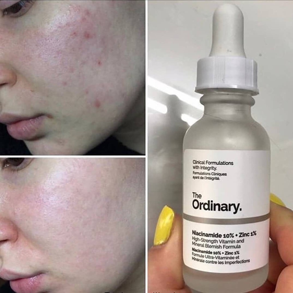 Serum The Ordinary Niacinamide 10%+ Zin C