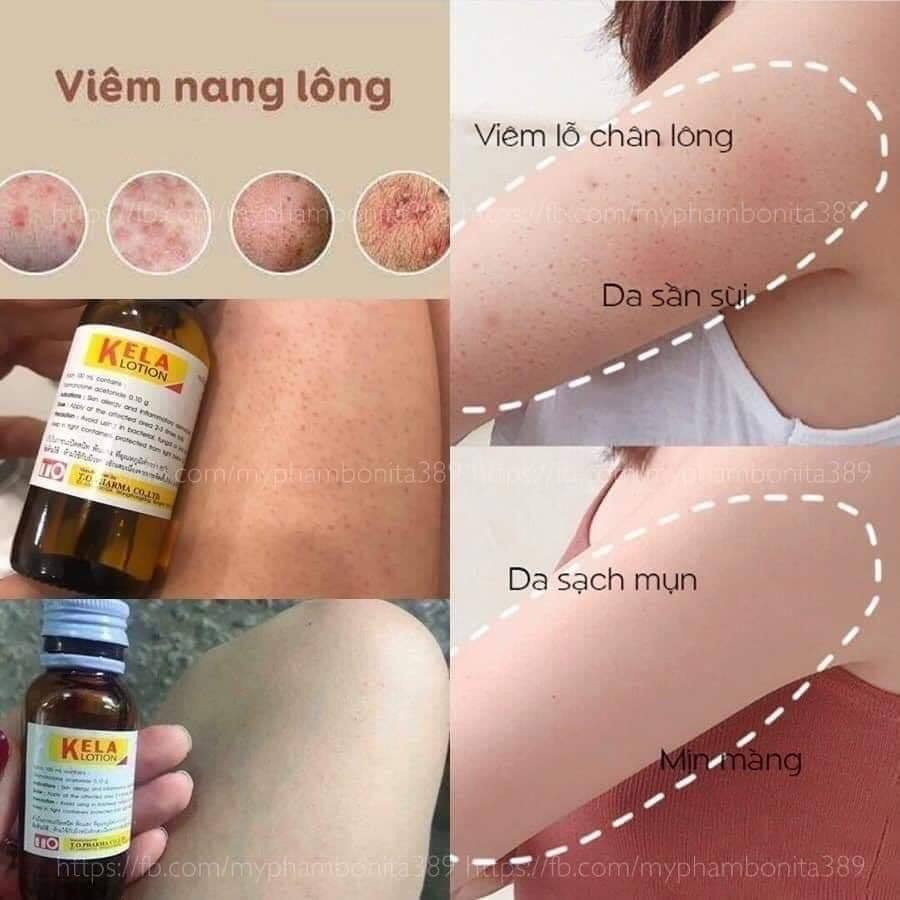 KELA LOTION Bôi Viêm Lỗ Chân Lông Thái Lan