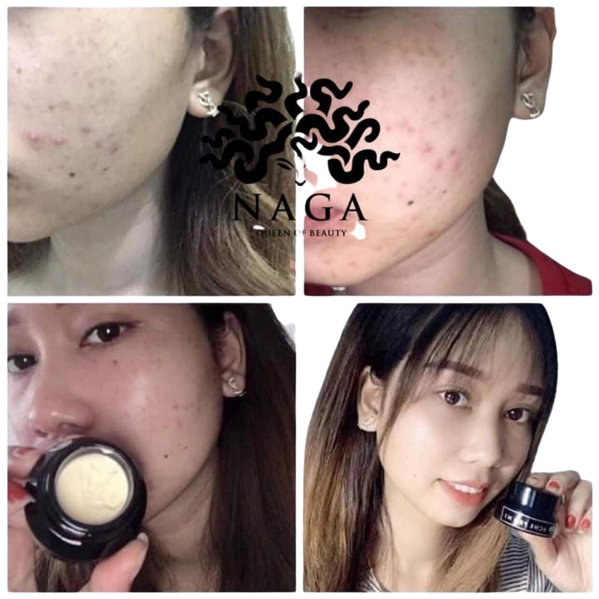 [Chính hãng] Kem chấm mụn mờ thâm, giảm nhanh mụn viêm, mụn thâm