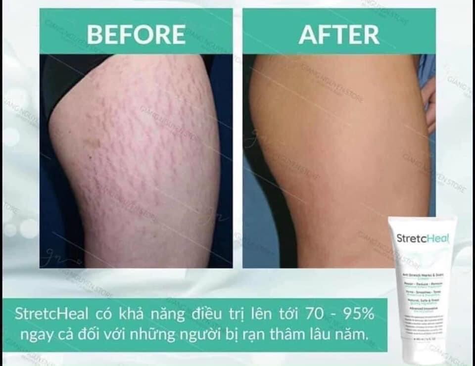 [GIẢM 5% ĐƠN 129K]Kem dưỡng da rạn StretcHeal