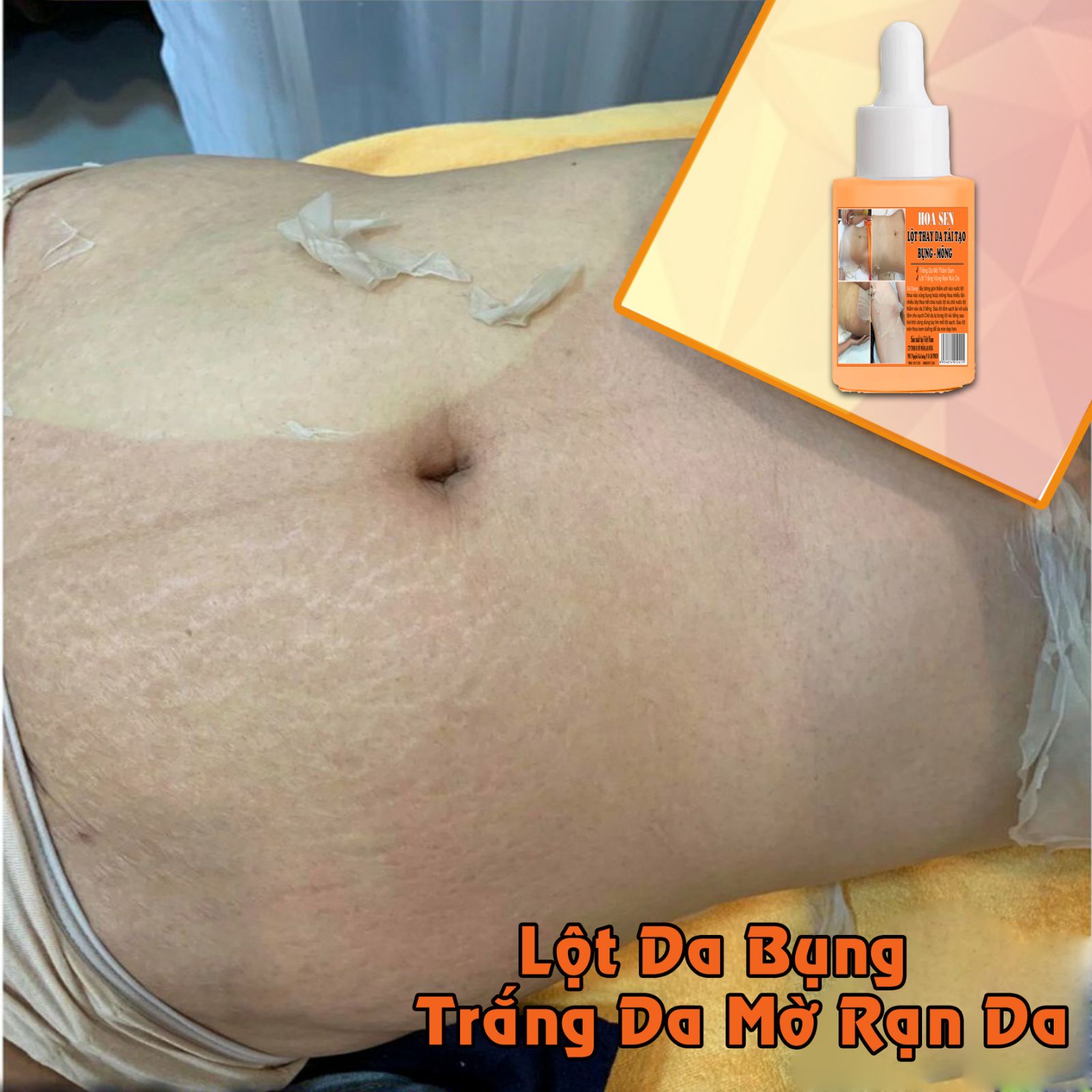 Lột Trắng Da Bụng Mông Bẹn Mờ Rạn Da Thâm Sạm