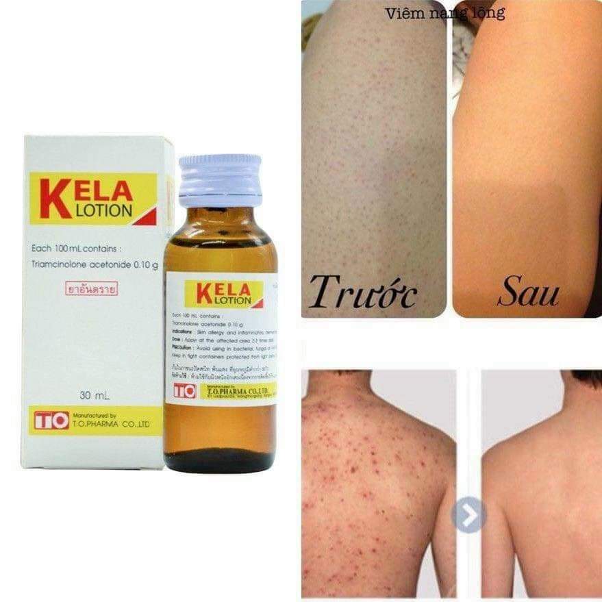 Kela Lotion bôi viêm nang lông, lỗ chân lông 30ml
