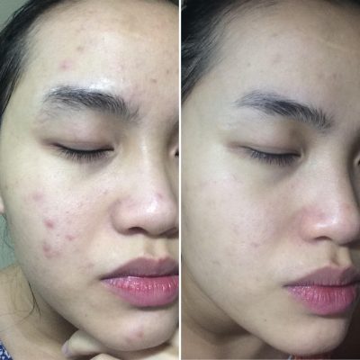 Tinh chất giảm mụn SVR Sebiaclear Serum 30ml