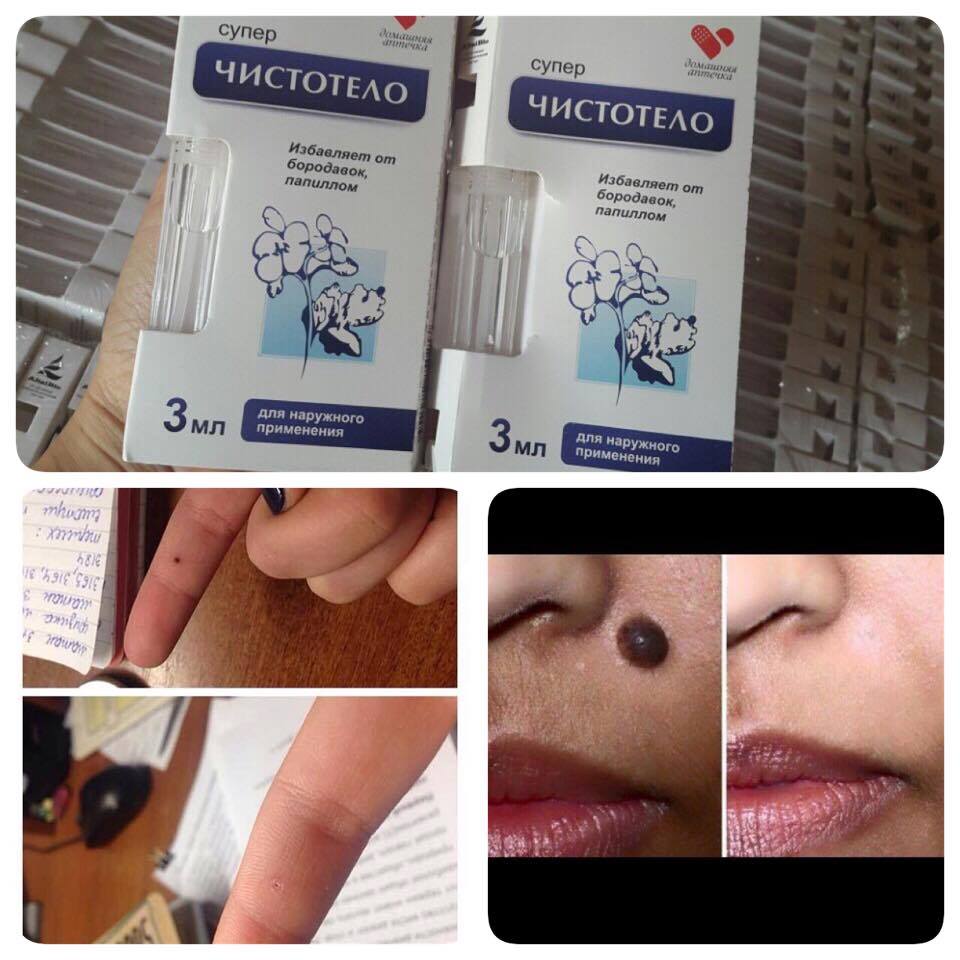 Gel Tẩy nốt ruồi Nga