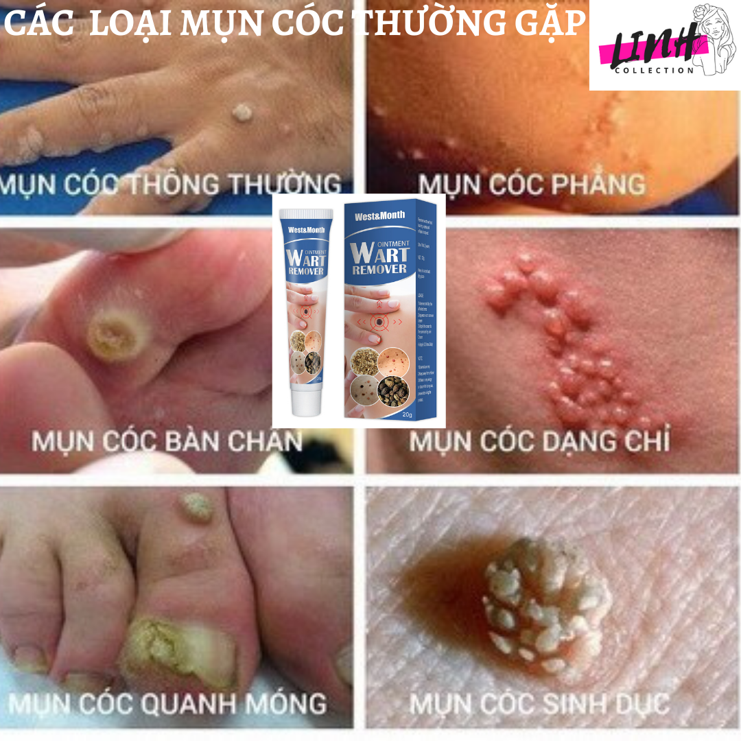 {ĐÁNH BẬT} MỤN CÓC, MỤN THỊT,MỤN CƠM,MỤN RUỒI TRÂU REMOVE EVERY WARTS CHÍNH HÃNG