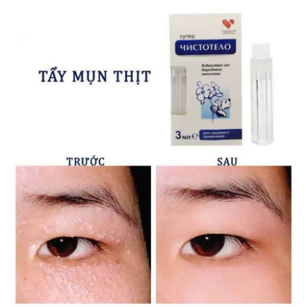 Gel tẩy nốt ruồi mụn cơm mụn cóc