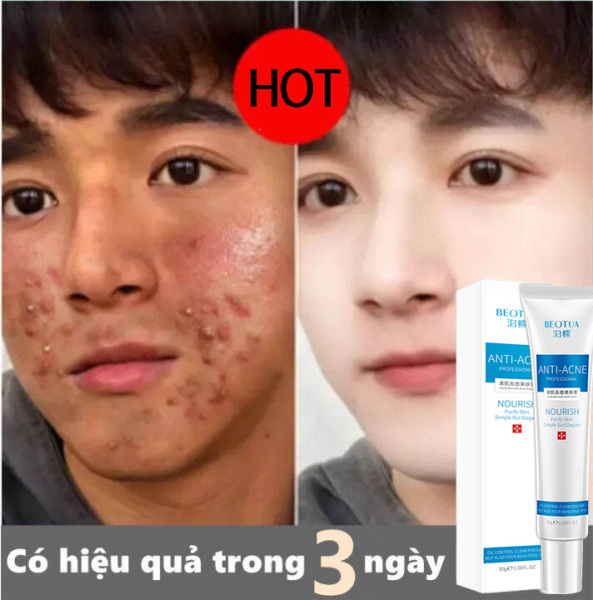 Gel chống mụn BEOTUA, xoá mụn hiệu quả ,làm mịn da và phục hồi da , dành cho nam nữ,Kiểm soát dầu thu nhỏ lỗ chân lông , làm trắng ,xoá mụn , kem dưỡng ẩm. giá rẻ