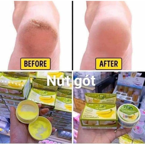 KEM NỨT GÓT CHÂN CHUỐI THÁI LAN hộp 30g