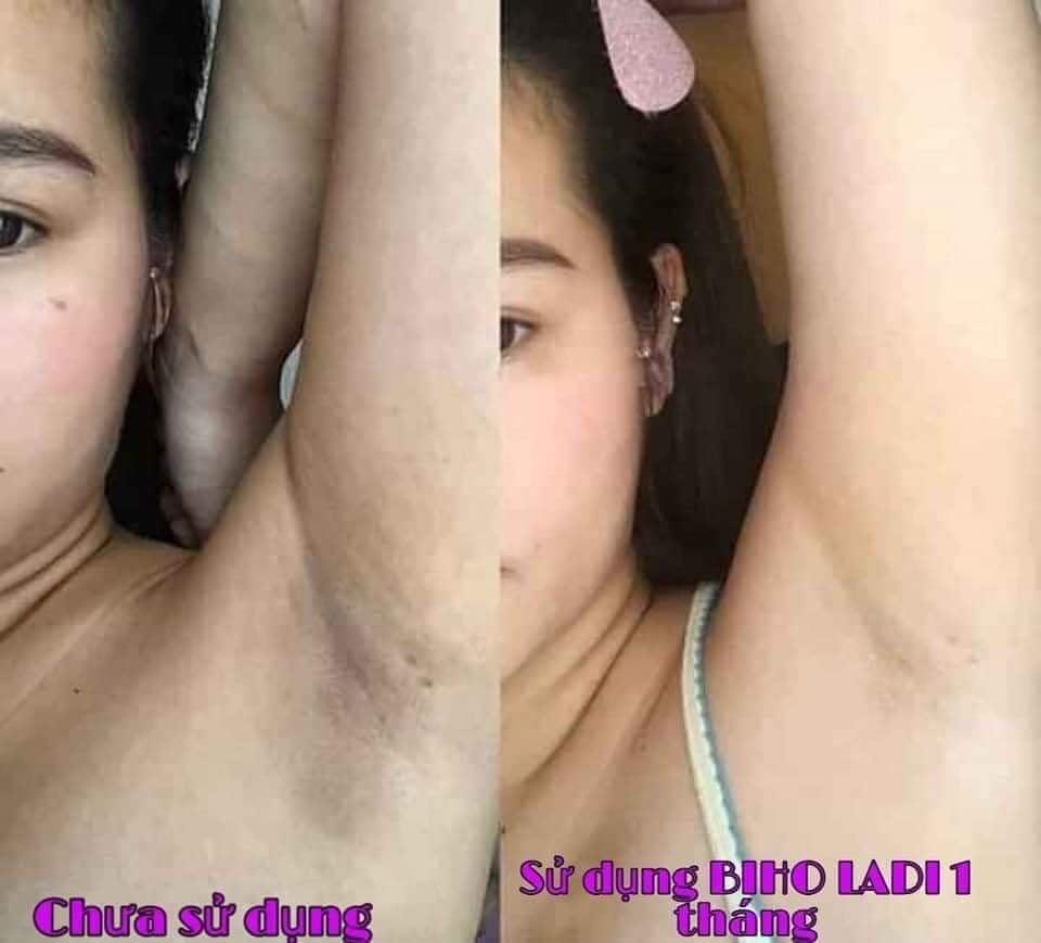 Siêu Dưỡng Thâm 5s Biho Ladi