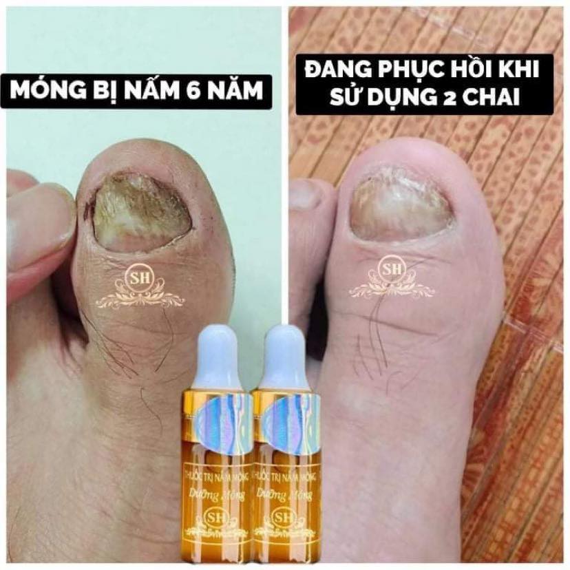 Thuốc Trị Nấm Móng SH