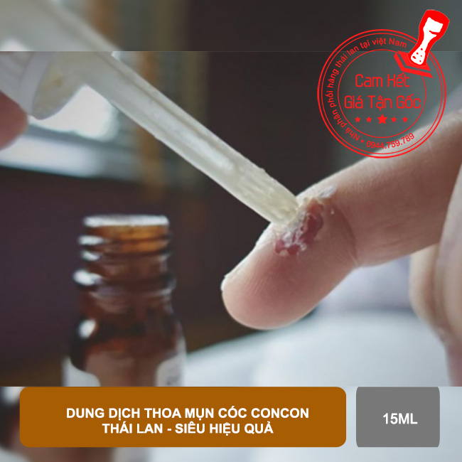 01 chai Dung dịch thoa giảm Mụn Cóc Concon Thái Lan 15ml