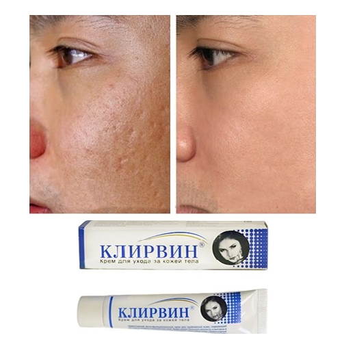 Kem Mờ Sẹo Nga Klirvin 25g – Giảm sẹo thâm, Sẹo lồi, Sẹo lõm, Vết rạn da, sẹo do bỏng