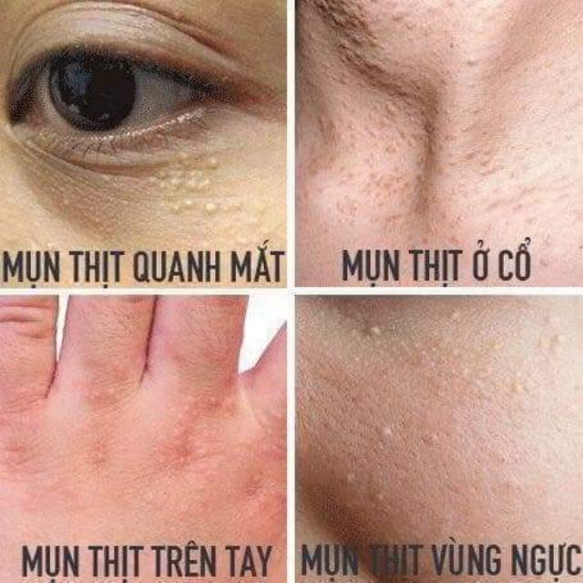 Kem Mụn Thịt