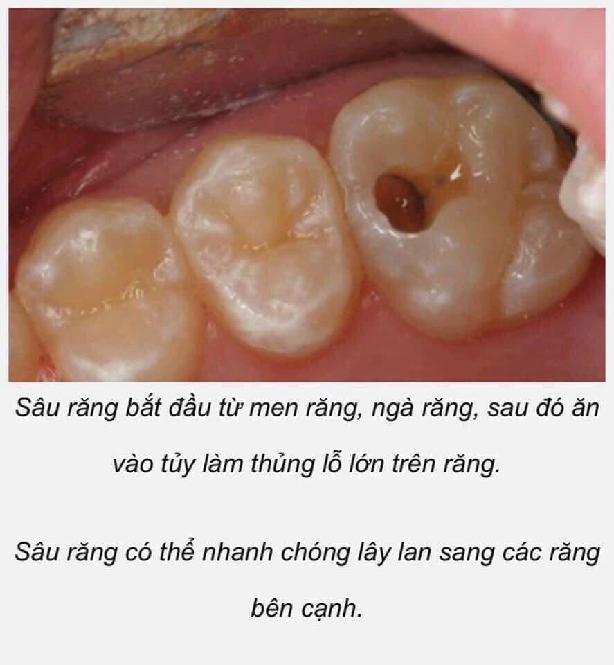 Dầu bôi đau nhức răng M.16 Patar 75 3ml