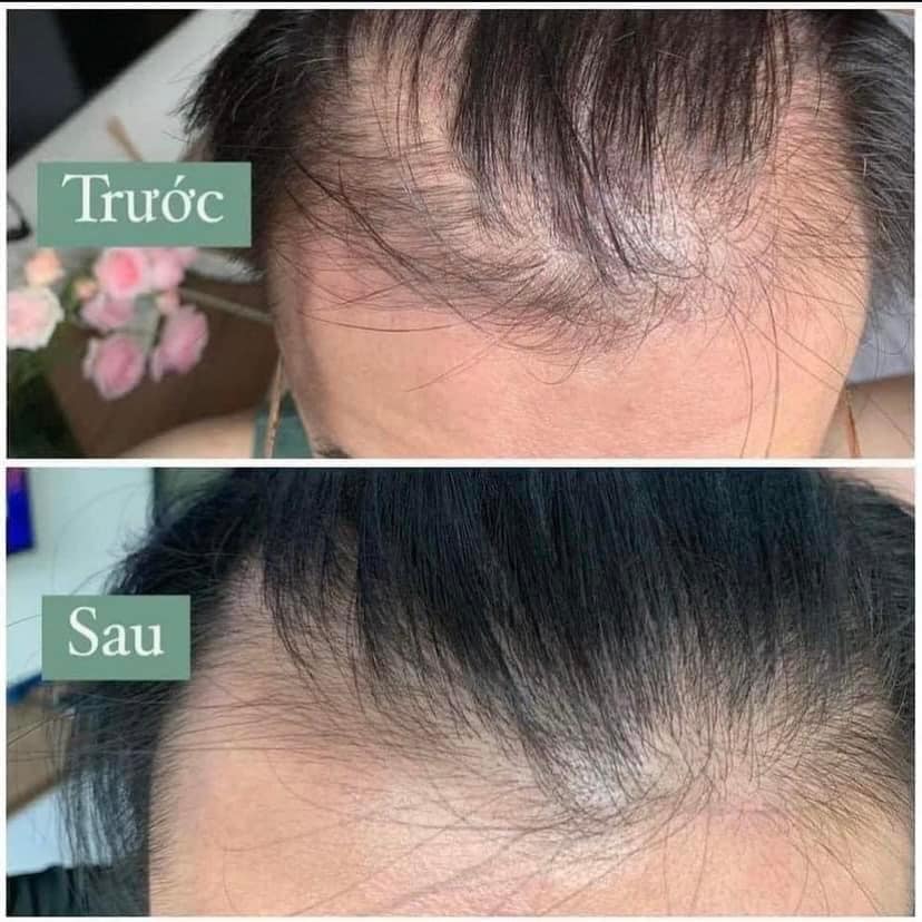 Xịt Mọc Tóc MINOXIDIL BAILLEUL 2% 5% - NGĂN RỤNG TÓC, KÍCH THÍCH MỌC TÓC