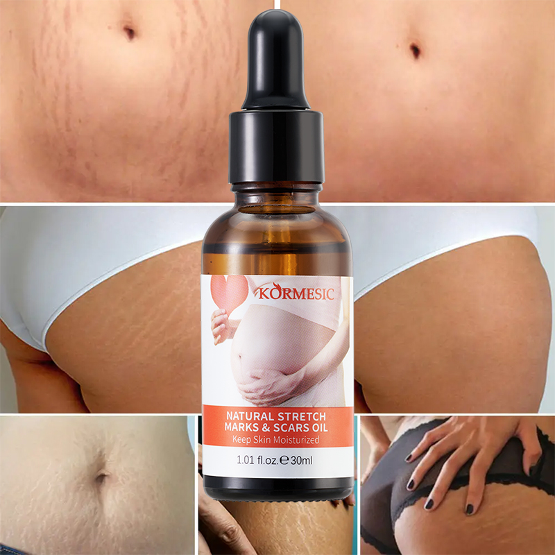 Tinh dầu trị rạn da KORMESIC 30ml