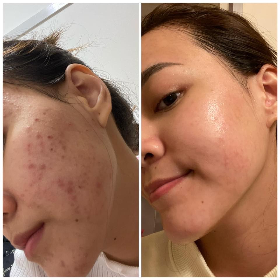 Trị mụn Dr Mai Mix safron lành tính 5ml