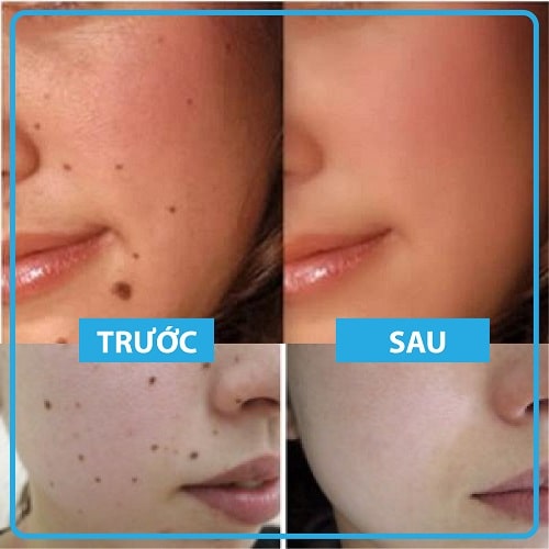 Gel chấm tàn nhang, nốt ruồi