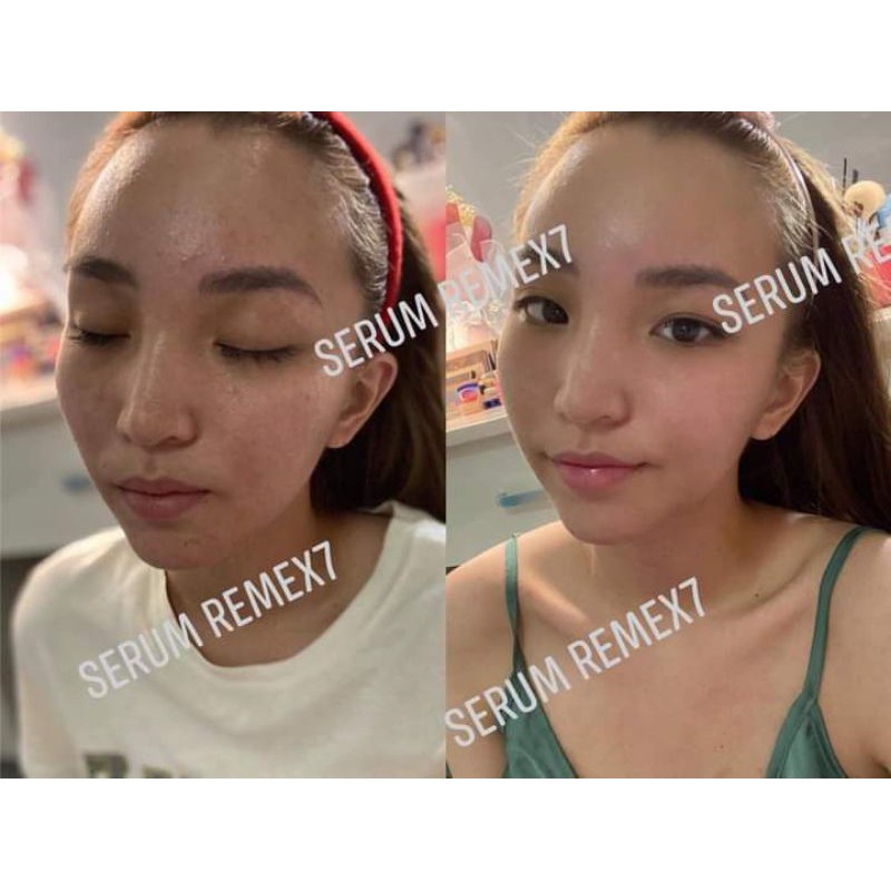 Serum Remex7 Tế bào gốc thực vật