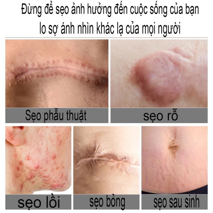 Kem xóa sẹo loại bỏ hiệu quả các vết sẹo lâu năm sẹo phẫu thuật phục ...