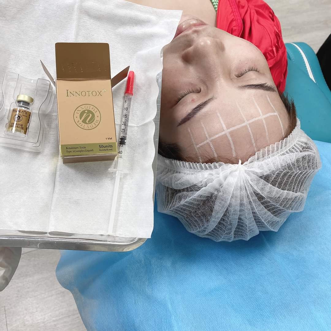 BOTOX INNOTOX 50 TIÊM CĂNG TRÁN CỰC ĐẸP ??