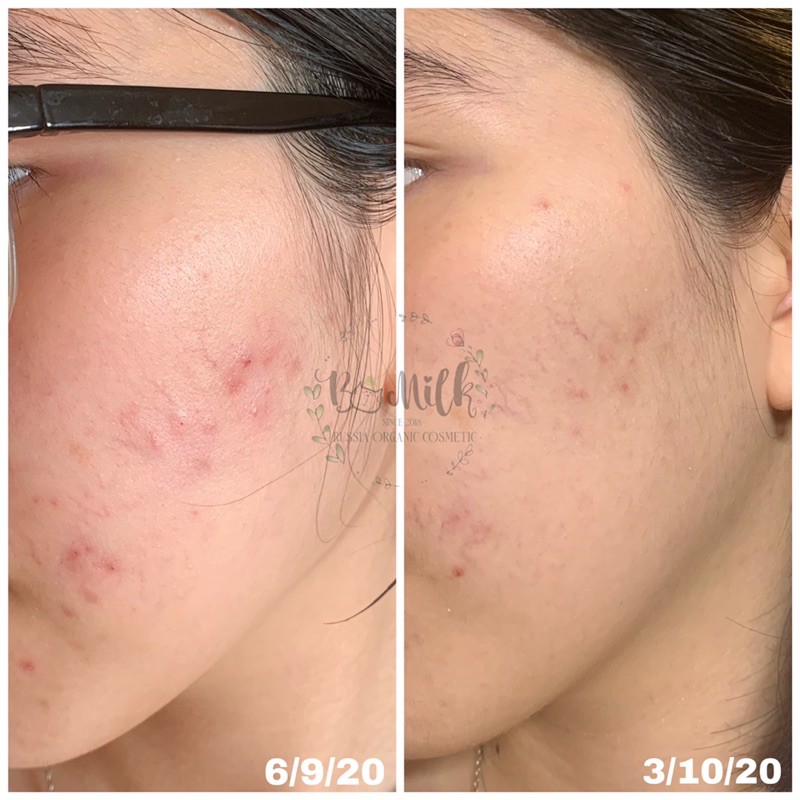 Serum Teana D6 Panthenol - Phục hồi, mờ thâm