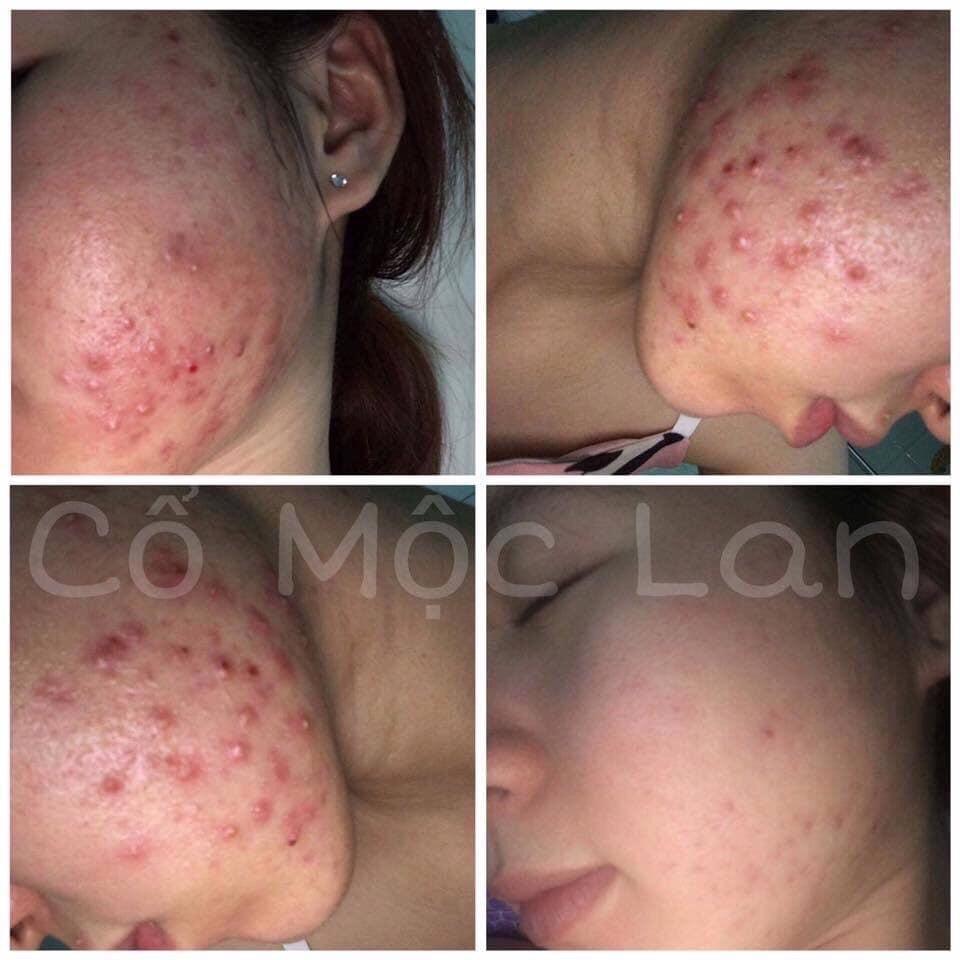 [HCM]Cổ mộc lan tái tạo 20ml