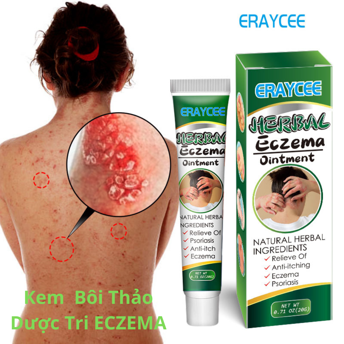 Xịt loại bỏ vẩy nến, chàm, kháng khuẩn, loại bỏ nấm da, chống ngứa, viêm da, hắc lào, lang ben, mề đay, viêm da cơ địa,...