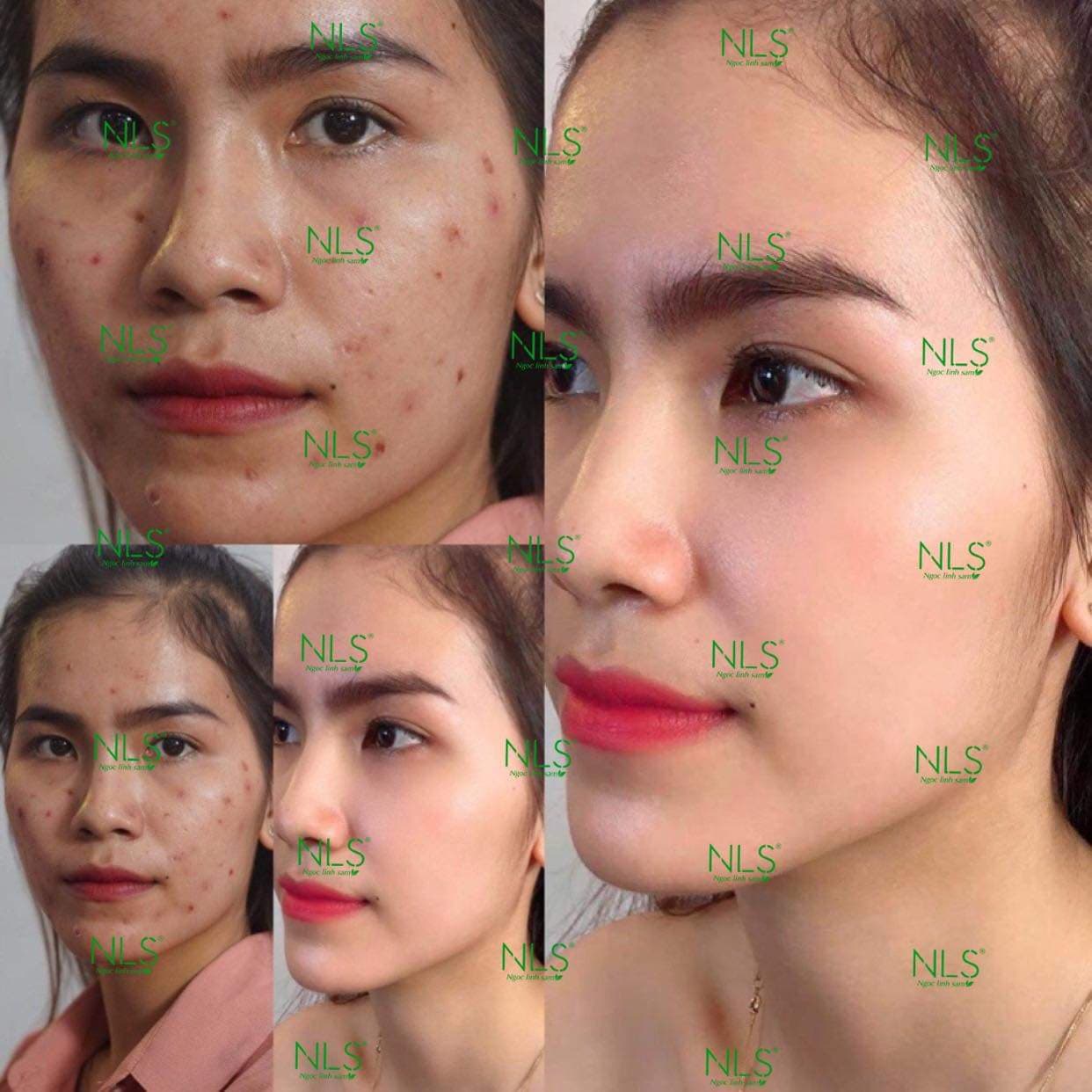 [HCM][CHÍNH HÃNG] SERUM THẢO DƯỢC NGỌC LINH SÂM ĐÁNH BAY MỤN NÁM