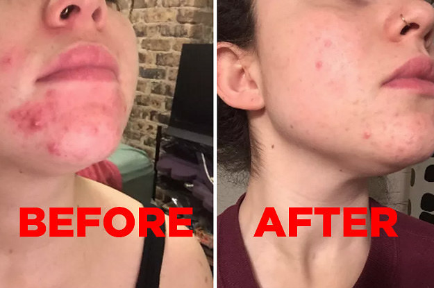 Mặt nạ đất sét Aztec Secret Healing Clay