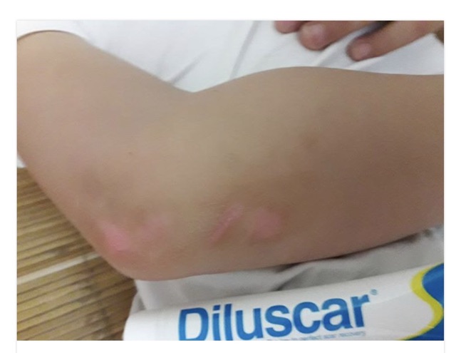 Kem ngừa sẹo Diluscar liền sẹo, mờ sẹo,...