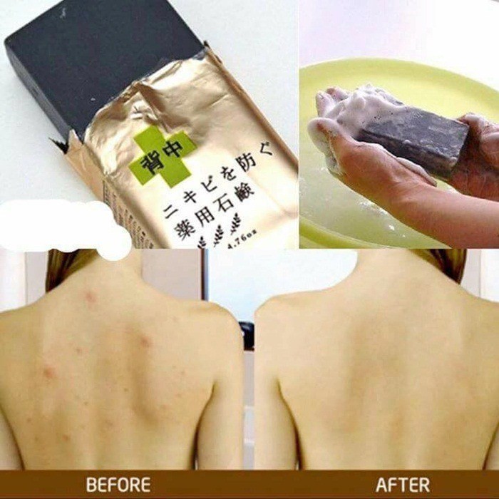 XÀ PHÒNG TRỊ MỤN LƯNG FOR BACK MEDICATED SOAP
