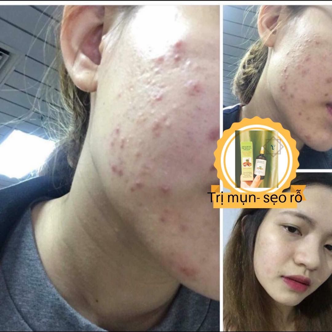 COMBO TÁI TẠO DA ( Tạm biệt mụn )