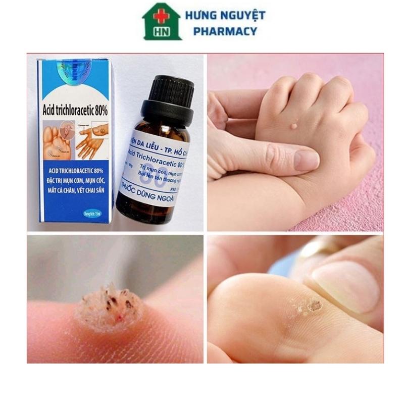 Lọ chấm mụn cơm, mụn cóc, mụn thịt, chai chân Acid Trichloracetic 80%