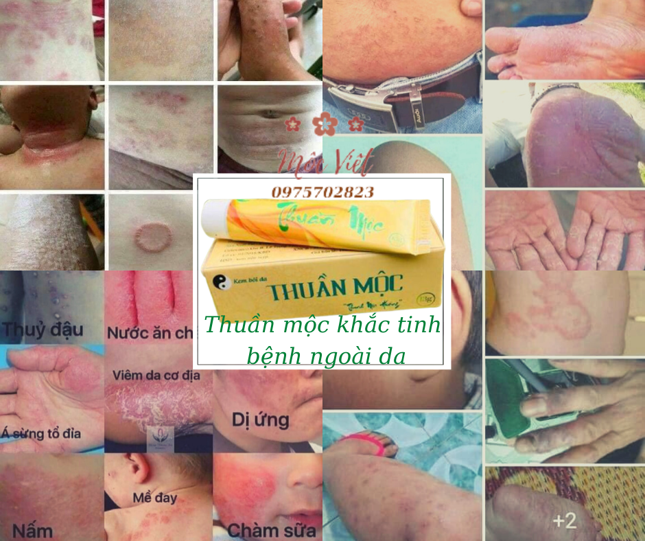 KEM BÔI DA THUẦN MỘC (MẪU MỚI)