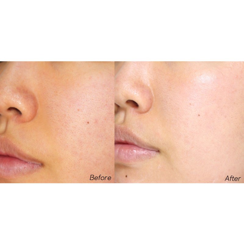 [DongSung Rannce] Serum nám 45ml