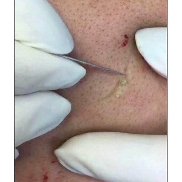 [HCM][SKIN HOUSE] 10 DAO NẶN MỤN SIÊU BÉN