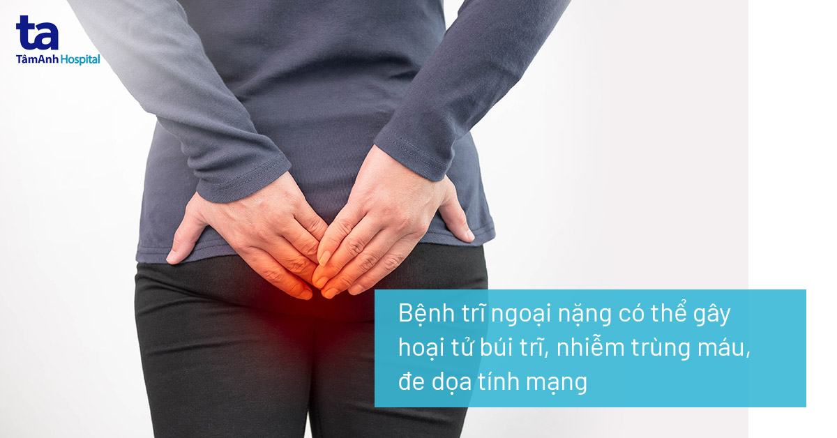 Hỗ trợ điều trị trĩ nội, trĩ ngoại VNP LADA