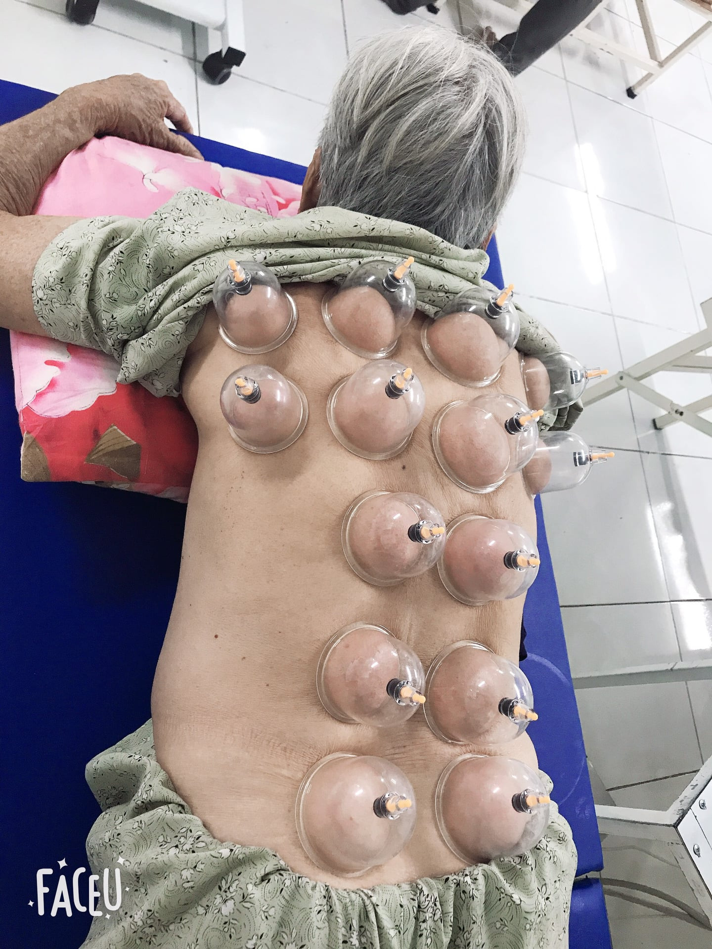 Bộ giác hơi 24 món , không cần lửa